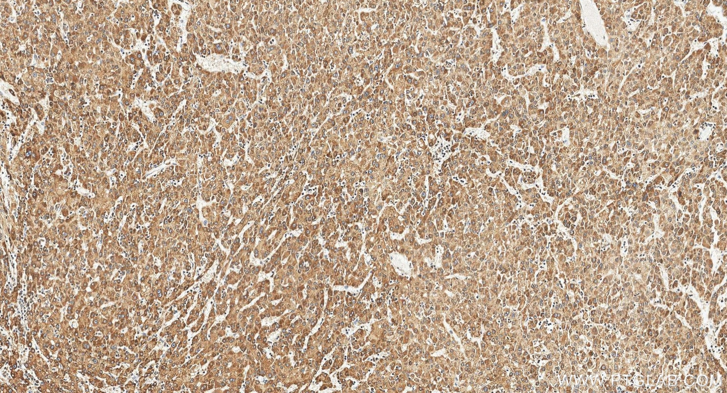Immunohistochemistry (IHC) staining of human liver cancer tissue using IQGAP2 Polyclonal antibody (55189-1-AP)
