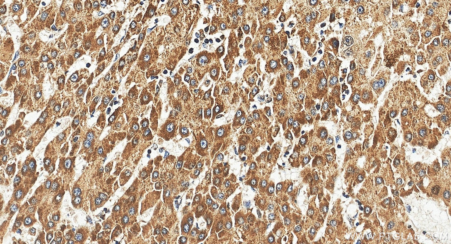 Immunohistochemistry (IHC) staining of human liver cancer tissue using IQGAP2 Polyclonal antibody (55189-1-AP)