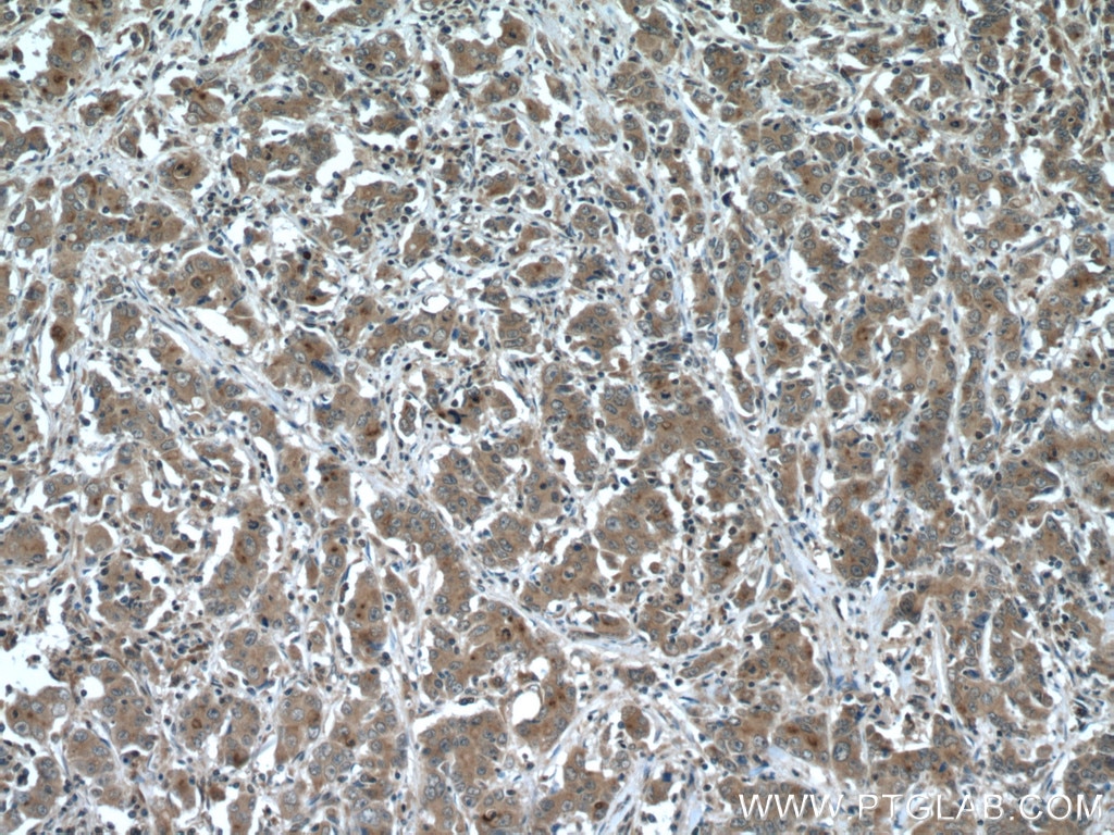 Immunohistochemistry (IHC) staining of human stomach cancer tissue using IQGAP3 Polyclonal antibody (25930-1-AP)