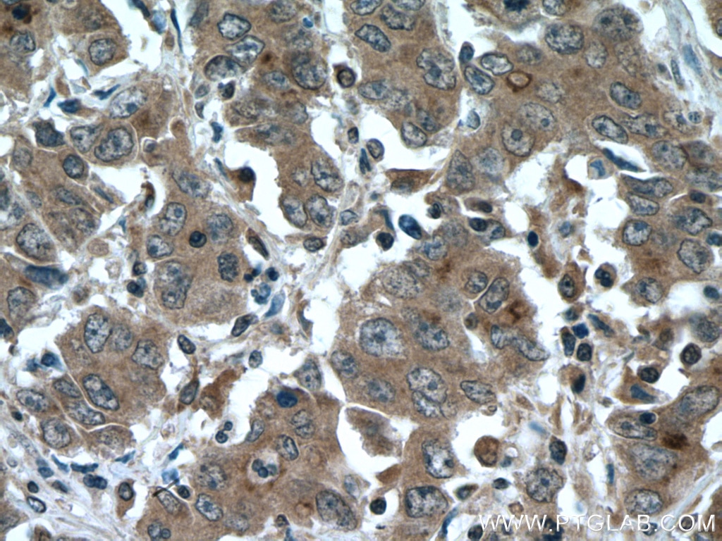 Immunohistochemistry (IHC) staining of human stomach cancer tissue using IQGAP3 Polyclonal antibody (25930-1-AP)