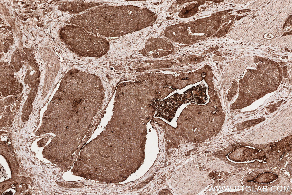 Immunohistochemistry (IHC) staining of human stomach cancer tissue using IQGAP3 Polyclonal antibody (25930-1-AP)