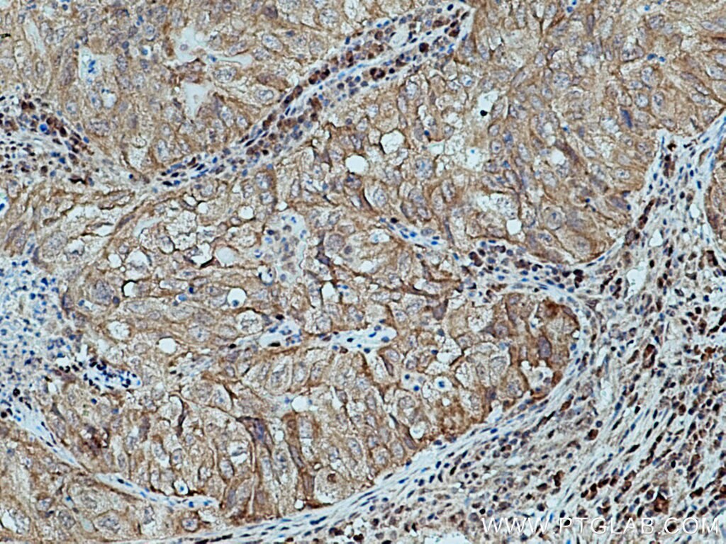 Immunohistochemistry (IHC) staining of human lung cancer tissue using IRAK1 Polyclonal antibody (10478-2-AP)