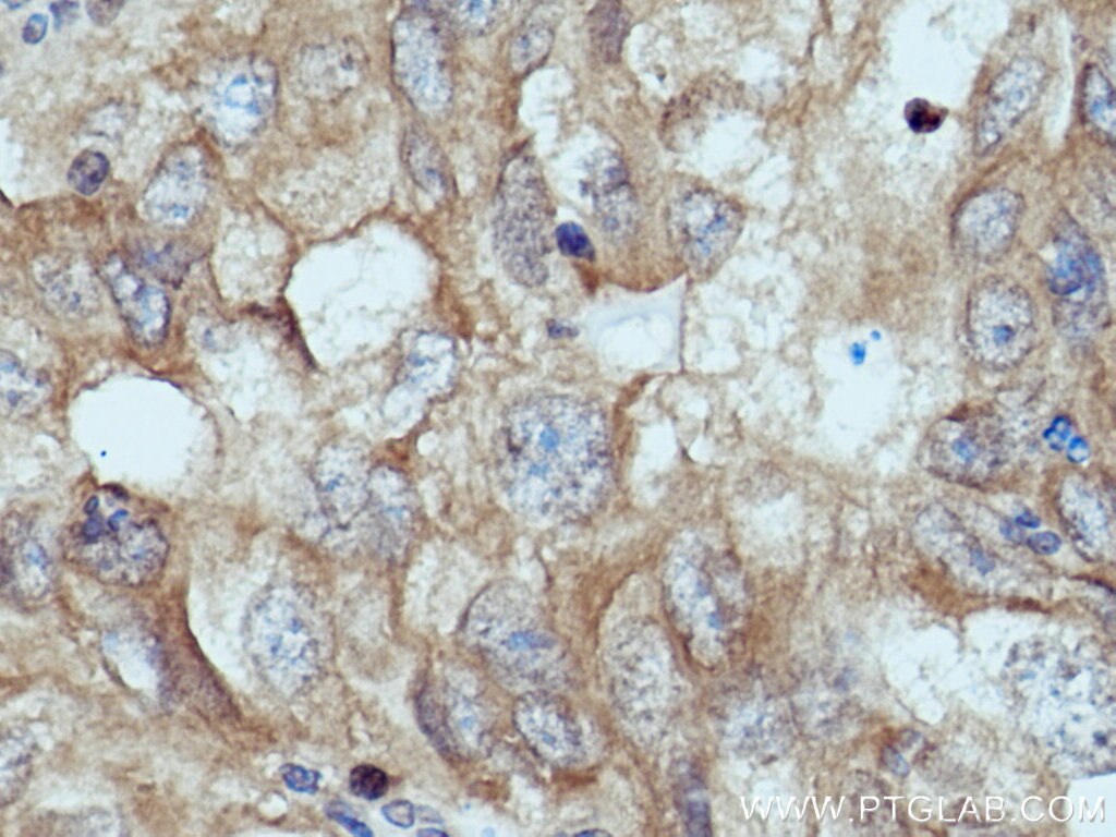 Immunohistochemistry (IHC) staining of human lung cancer tissue using IRAK1 Polyclonal antibody (10478-2-AP)