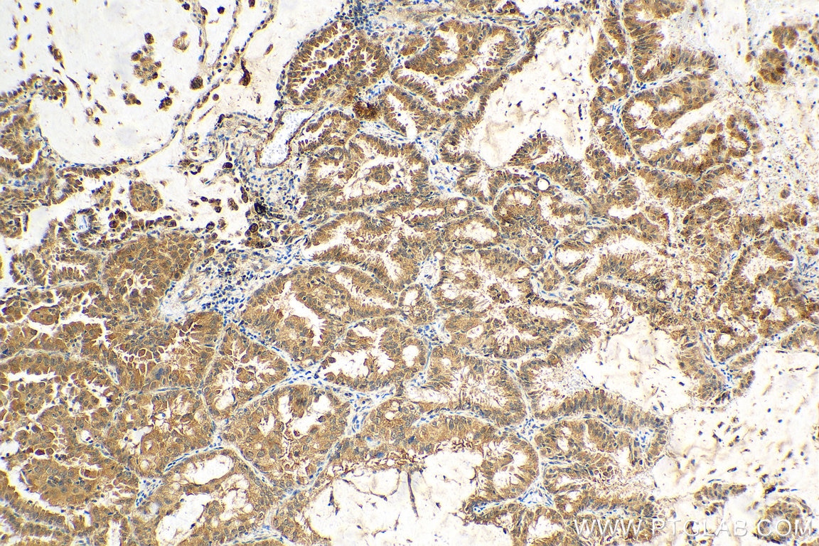 Immunohistochemistry (IHC) staining of human lung cancer tissue using IRAK1 Polyclonal antibody (10478-2-AP)