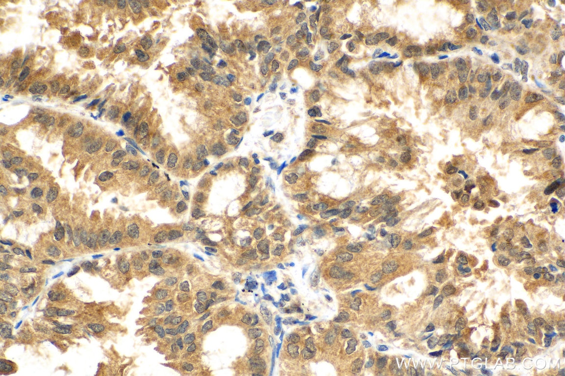 Immunohistochemistry (IHC) staining of human lung cancer tissue using IRAK1 Polyclonal antibody (10478-2-AP)