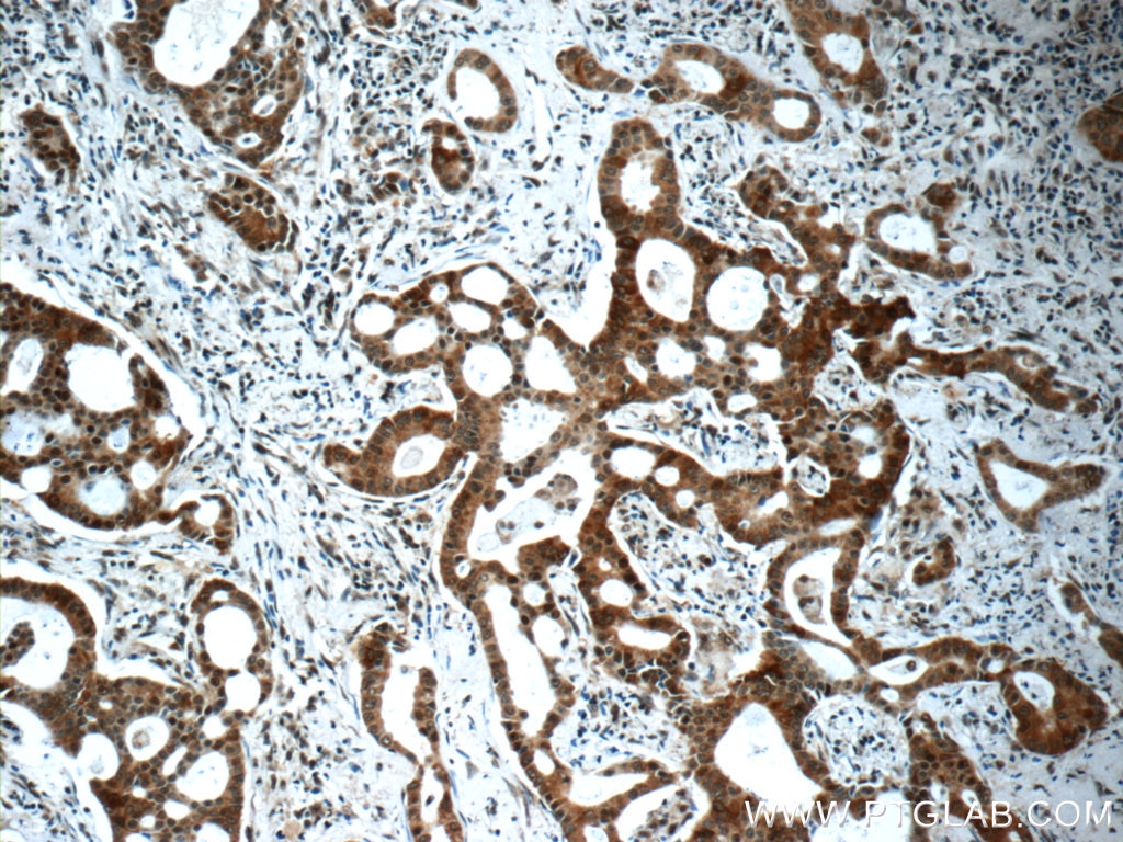 Immunohistochemistry (IHC) staining of human lung cancer tissue using IRAK1 Polyclonal antibody (10478-2-AP)