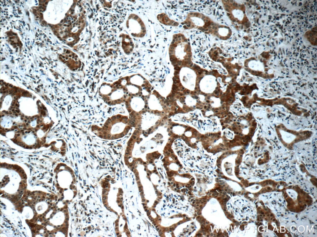 IHC staining of human lung cancer using 10478-2-AP