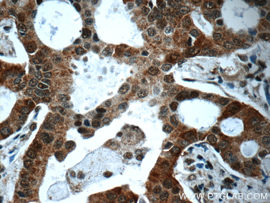 Immunohistochemistry (IHC) staining of human lung cancer tissue using IRAK1 Polyclonal antibody (10478-2-AP)