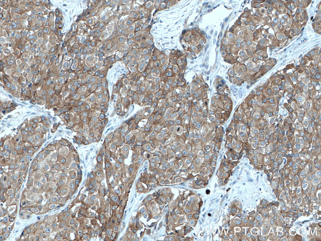 Immunohistochemistry (IHC) staining of human lung cancer tissue using IRAK1 Monoclonal antibody (66653-1-Ig)
