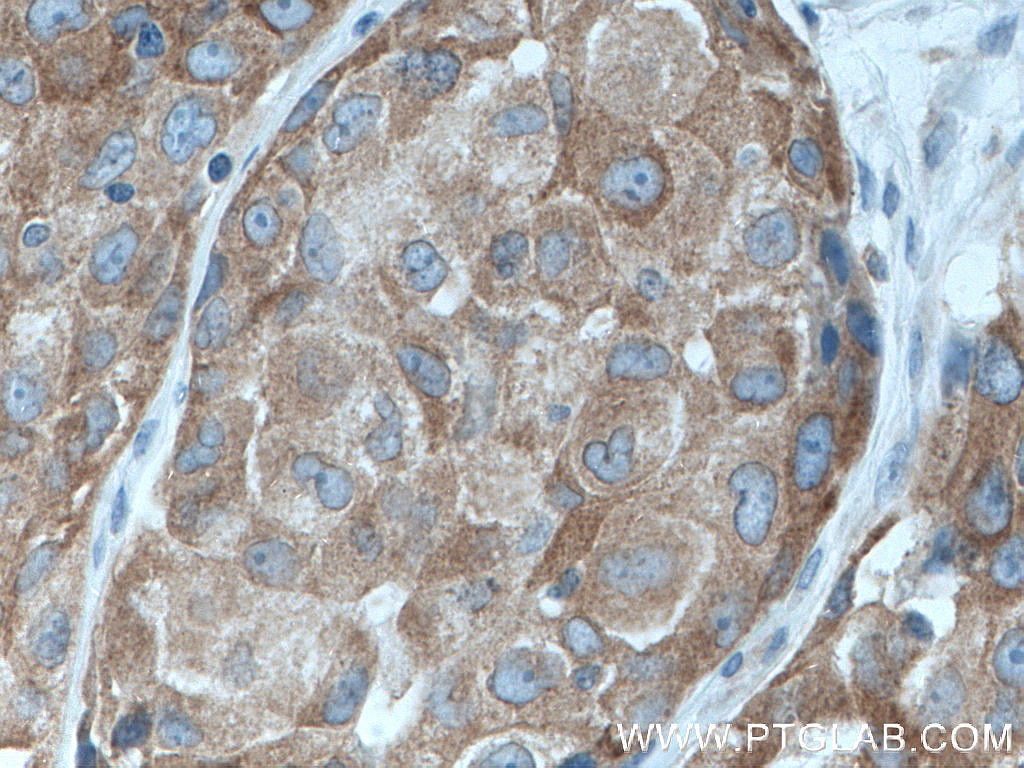 Immunohistochemistry (IHC) staining of human lung cancer tissue using IRAK1 Monoclonal antibody (66653-1-Ig)