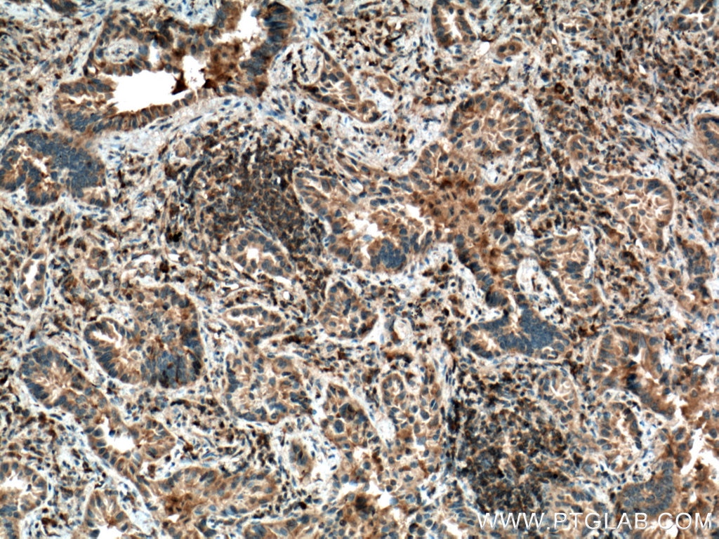 Immunohistochemistry (IHC) staining of human lung cancer tissue using IRAK4 Polyclonal antibody (18221-1-AP)