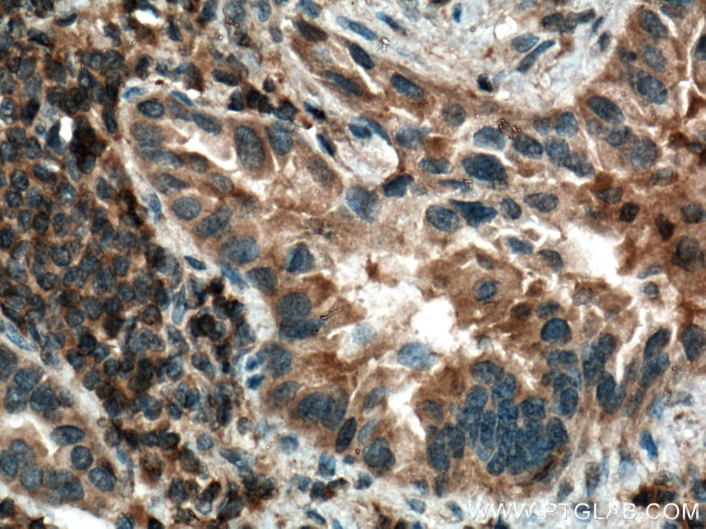 Immunohistochemistry (IHC) staining of human lung cancer tissue using IRAK4 Polyclonal antibody (18221-1-AP)