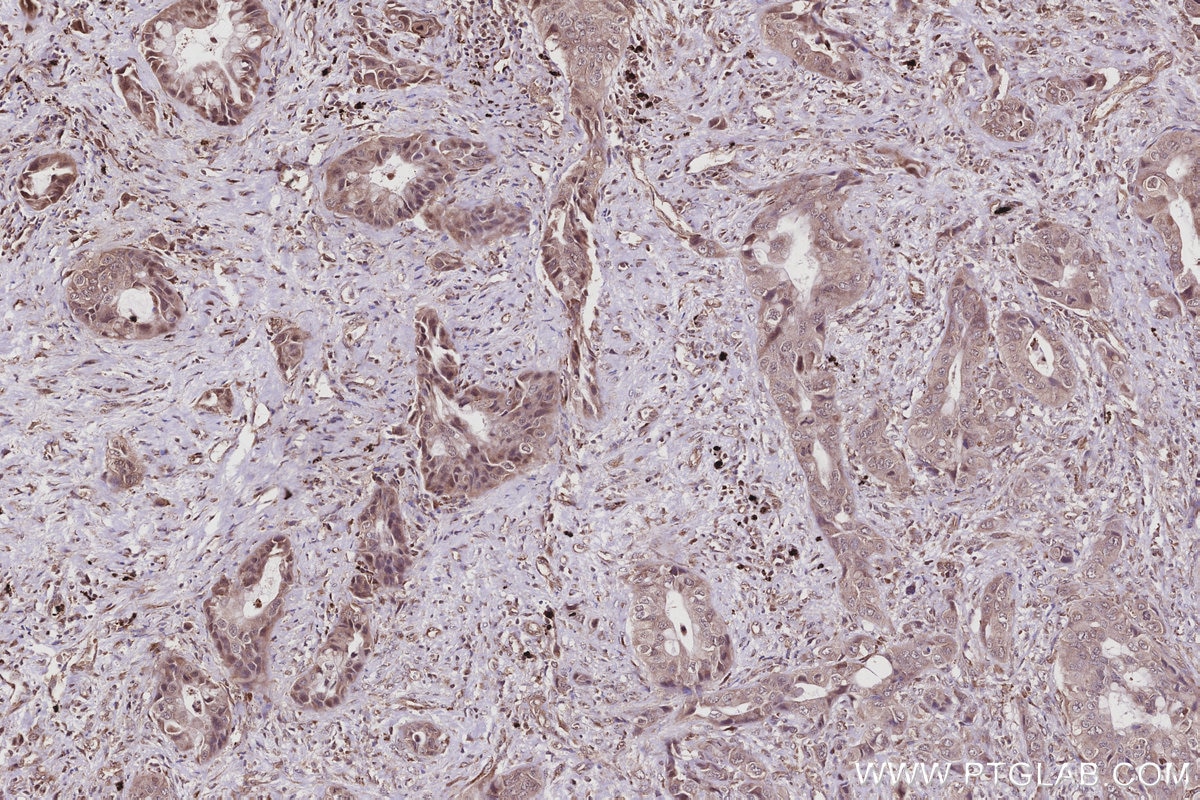 Immunohistochemistry (IHC) staining of human pancreas cancer tissue using IRAK4 Monoclonal antibody (67180-1-Ig)