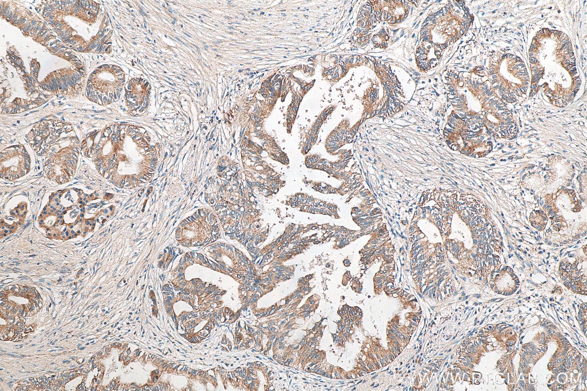 Immunohistochemistry (IHC) staining of human pancreas cancer tissue using IRE1; ERN1 Polyclonal antibody (27528-1-AP)