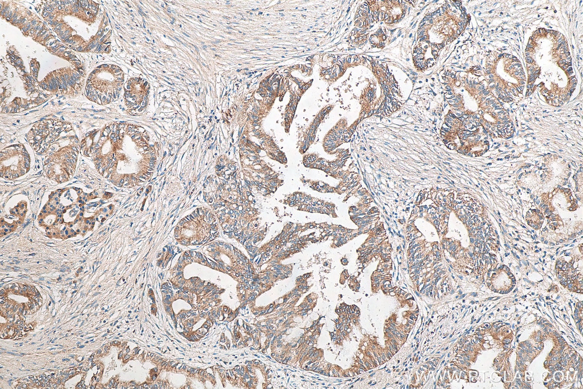 IHC staining of human pancreas cancer using 27528-1-AP