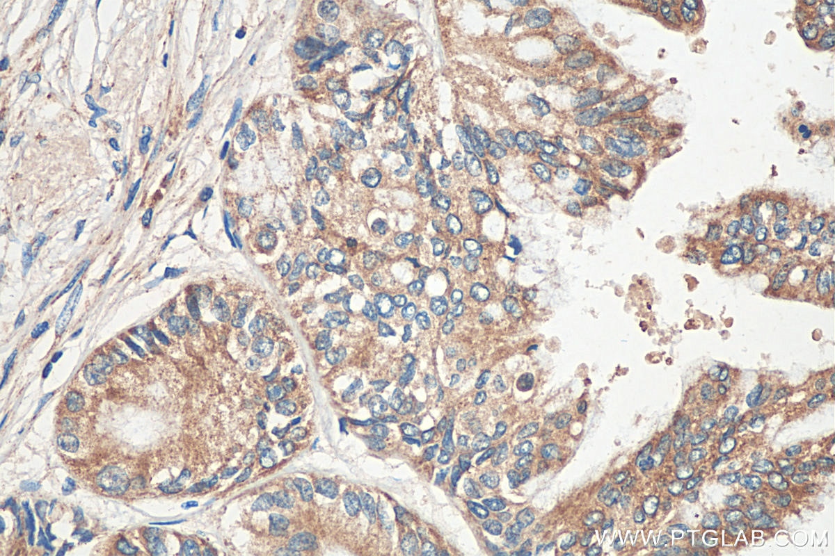 Immunohistochemistry (IHC) staining of human pancreas cancer tissue using IRE1; ERN1 Polyclonal antibody (27528-1-AP)