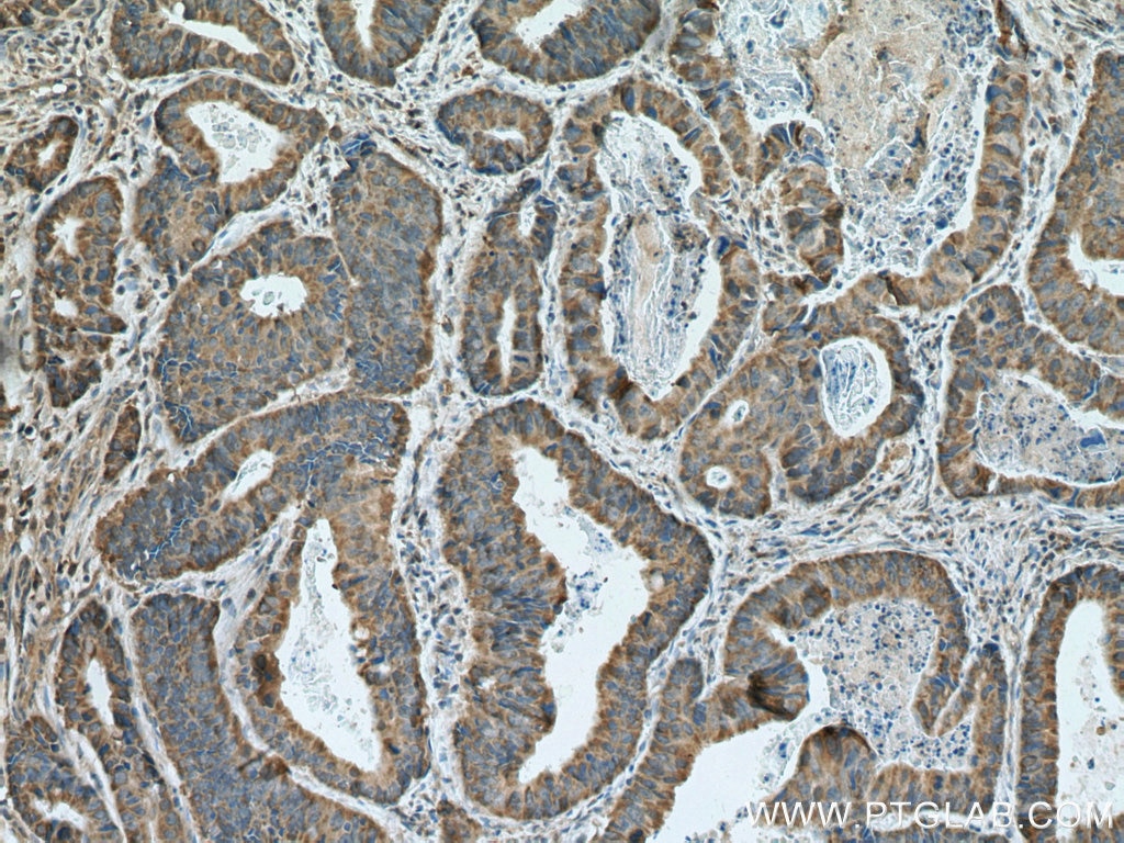 Immunohistochemistry (IHC) staining of human colon cancer tissue using IREB2 Polyclonal antibody (23829-1-AP)