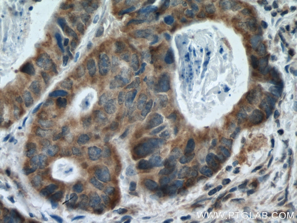 Immunohistochemistry (IHC) staining of human colon cancer tissue using IREB2 Polyclonal antibody (23829-1-AP)
