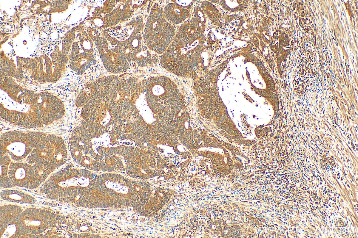 Immunohistochemistry (IHC) staining of human colon cancer tissue using IREB2 Polyclonal antibody (29976-1-AP)