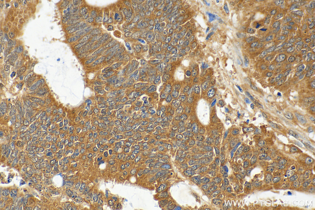 Immunohistochemistry (IHC) staining of human colon cancer tissue using IREB2 Polyclonal antibody (29976-1-AP)