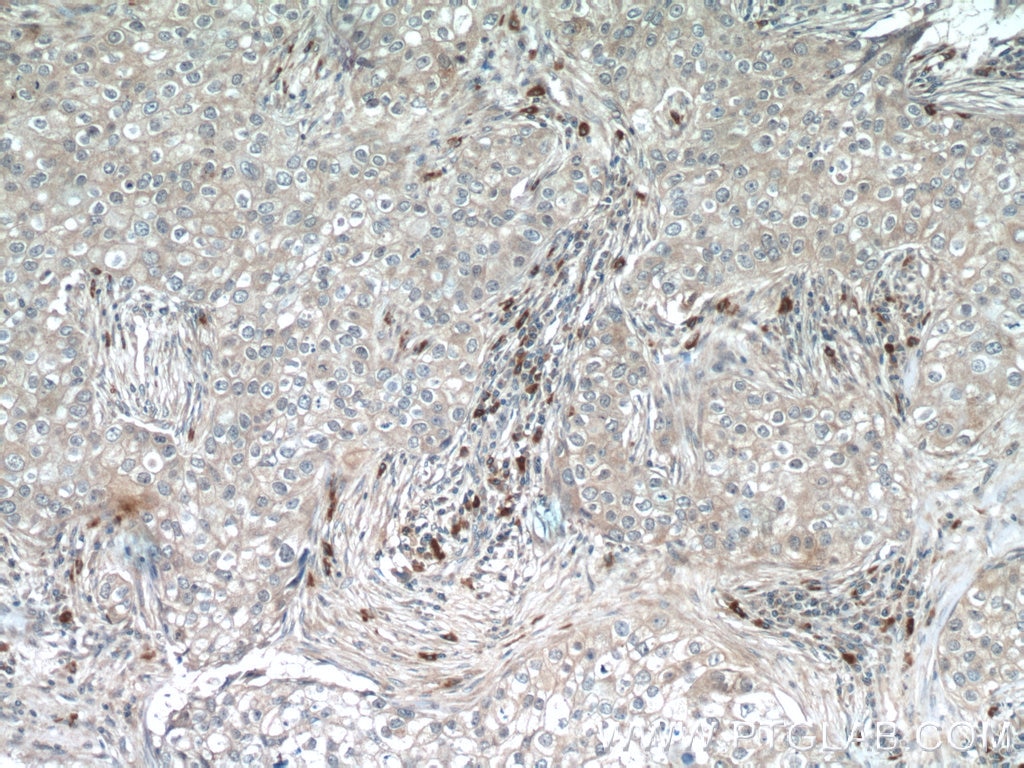 Immunohistochemistry (IHC) staining of human breast cancer tissue using IRF1 Polyclonal antibody (11335-1-AP)