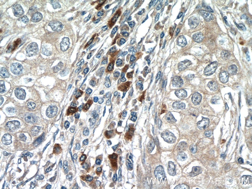 Immunohistochemistry (IHC) staining of human breast cancer tissue using IRF1 Polyclonal antibody (11335-1-AP)