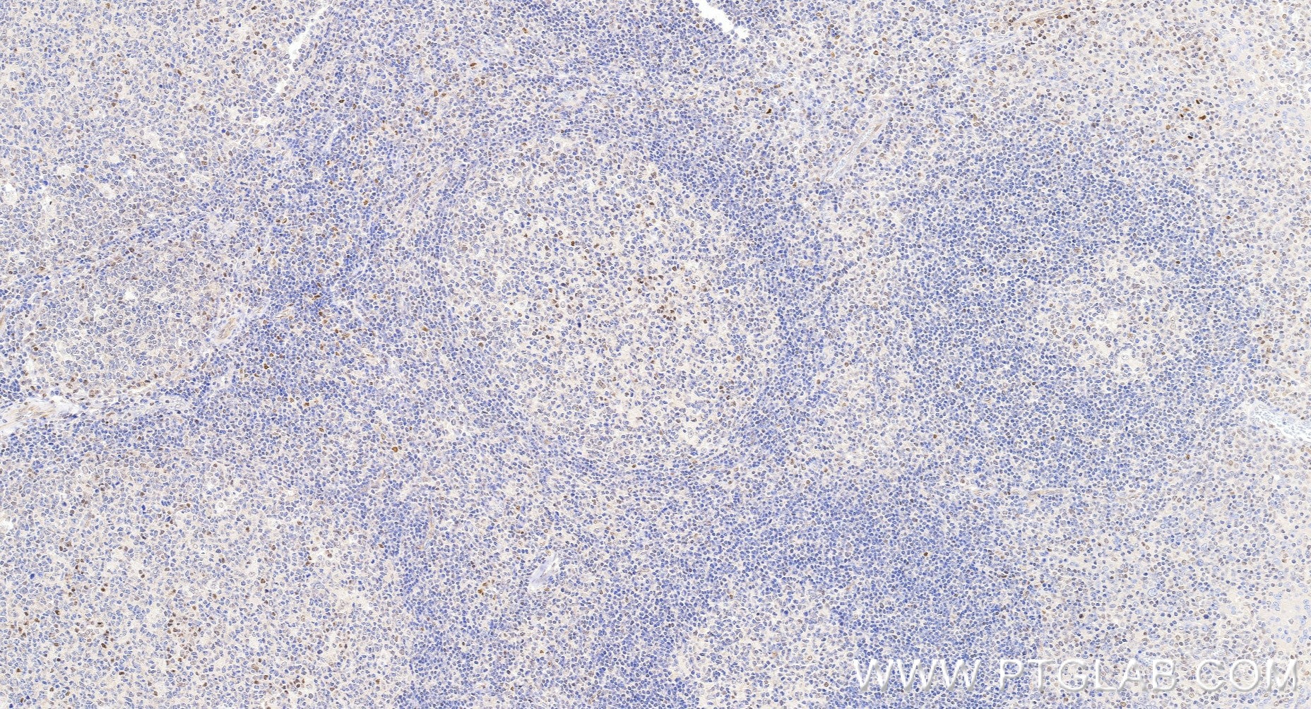 Immunohistochemical analysis of paraffin-embedded human tonsillitis tissue slide using 85254-3-RR (IRF1 antibody) at dilution of 1:1000 (under 20x lens). Heat mediated antigen retrieval with Tris-EDTA buffer (pH 9.0). Immunohistochemistry (IHC) staining of human tonsillitis tissue using IRF1 Recombinant monoclonal antibody (85254-3-RR)