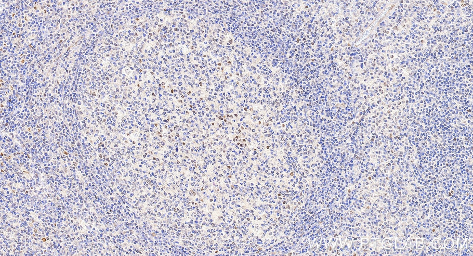 Immunohistochemical analysis of paraffin-embedded human tonsillitis tissue slide using 85254-3-RR (IRF1 antibody) at dilution of 1:1000 (under 20x lens). Heat mediated antigen retrieval with Tris-EDTA buffer (pH 9.0). Immunohistochemistry (IHC) staining of human tonsillitis tissue using IRF1 Recombinant monoclonal antibody (85254-3-RR)