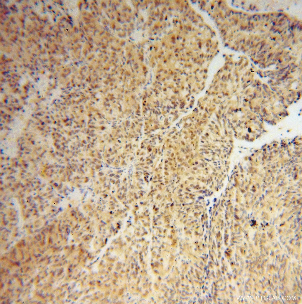 Immunohistochemistry (IHC) staining of human colon cancer tissue using IRF2 Polyclonal antibody (12525-1-AP)