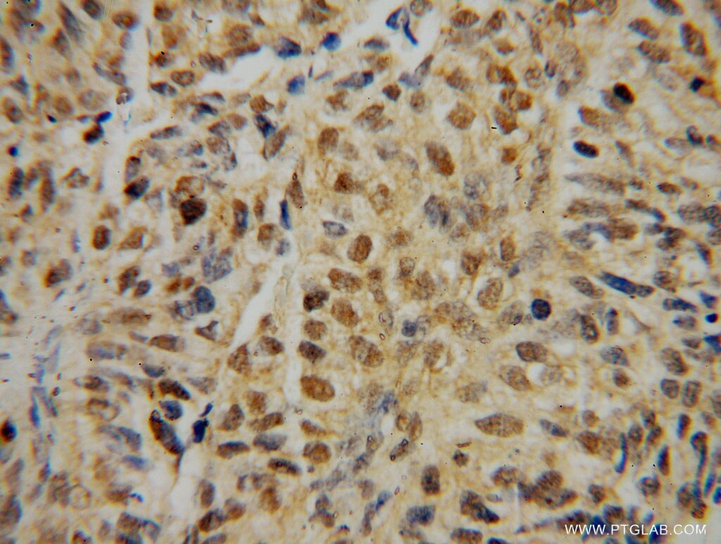 Immunohistochemistry (IHC) staining of human colon cancer tissue using IRF2 Polyclonal antibody (12525-1-AP)