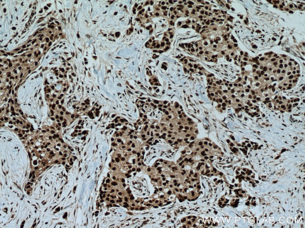 Immunohistochemistry (IHC) staining of human breast cancer tissue using IRF2BP1 Polyclonal antibody (13698-1-AP)