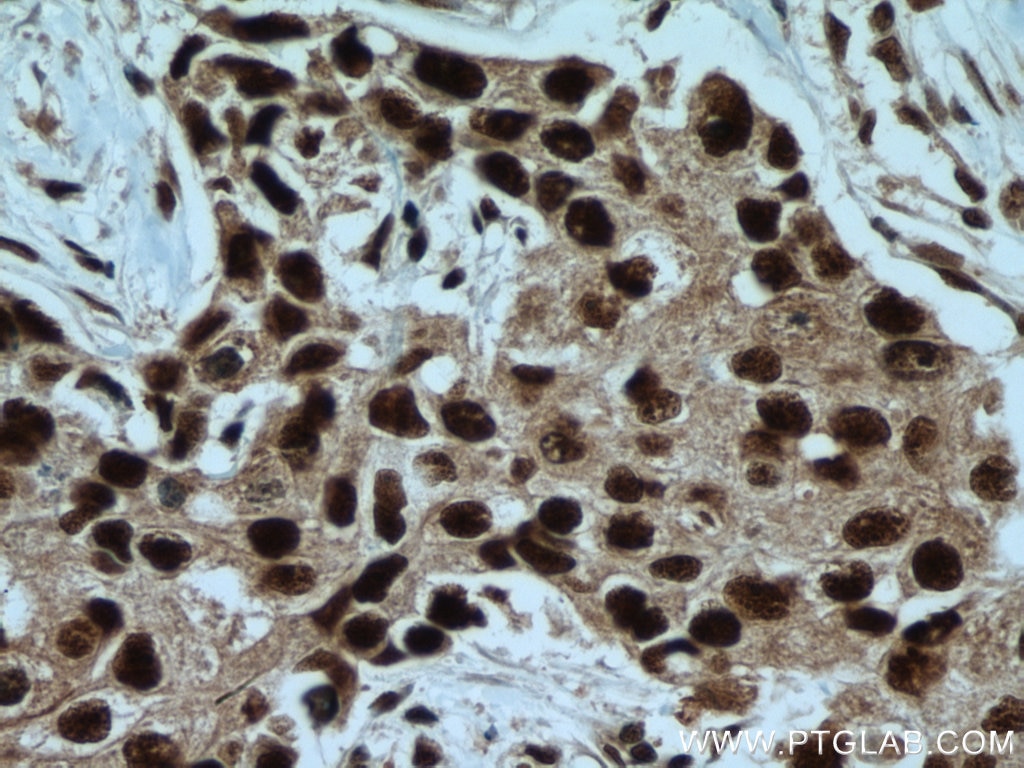 Immunohistochemistry (IHC) staining of human breast cancer tissue using IRF2BP1 Polyclonal antibody (13698-1-AP)