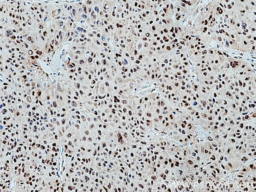 Immunohistochemistry (IHC) staining of human liver cancer tissue using IRF2BP2 Polyclonal antibody (18847-1-AP)