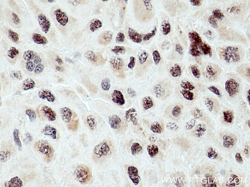Immunohistochemistry (IHC) staining of human liver cancer tissue using IRF2BP2 Polyclonal antibody (18847-1-AP)