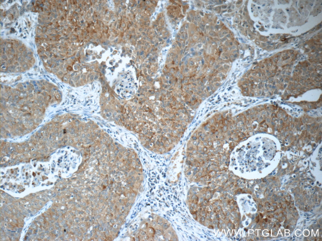 Immunohistochemistry (IHC) staining of human lung cancer tissue using IRF2BP2 Polyclonal antibody (18847-1-AP)