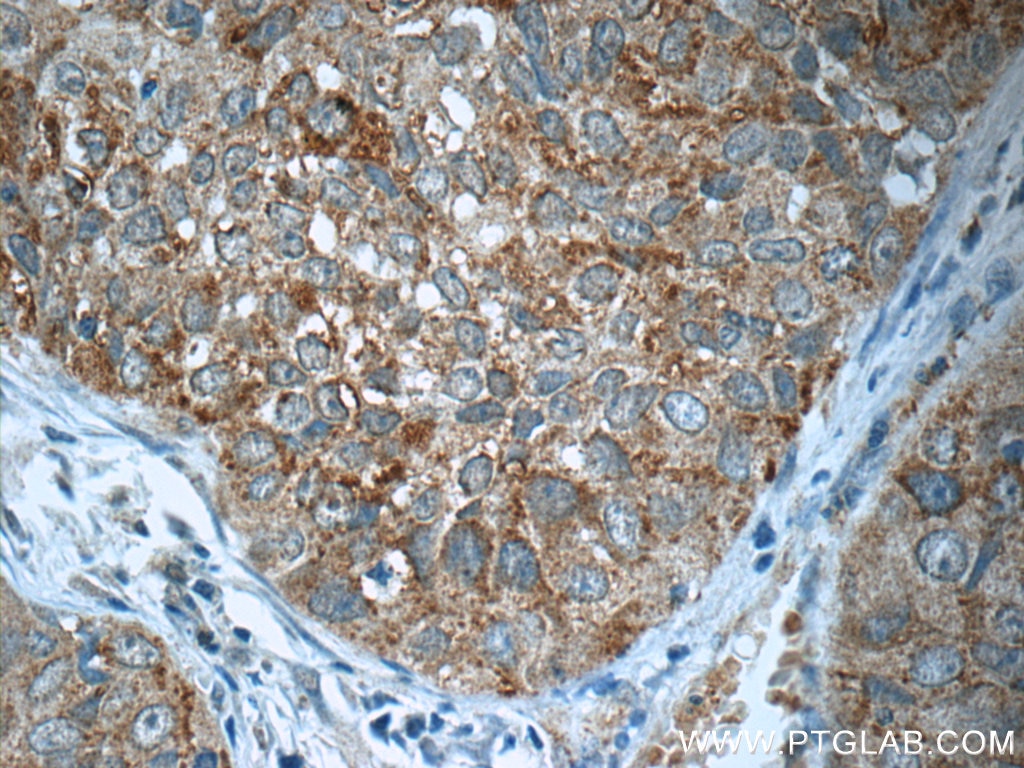 Immunohistochemistry (IHC) staining of human lung cancer tissue using IRF2BP2 Polyclonal antibody (18847-1-AP)