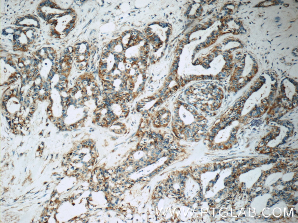Immunohistochemistry (IHC) staining of human breast cancer tissue using IRF2BP2 Polyclonal antibody (18847-1-AP)