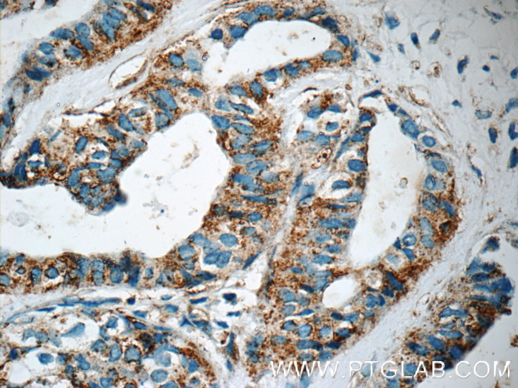 Immunohistochemistry (IHC) staining of human breast cancer tissue using IRF2BP2 Polyclonal antibody (18847-1-AP)
