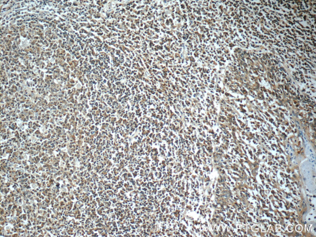 Immunohistochemistry (IHC) staining of human tonsillitis tissue using IRF3 Polyclonal antibody (11312-1-AP)