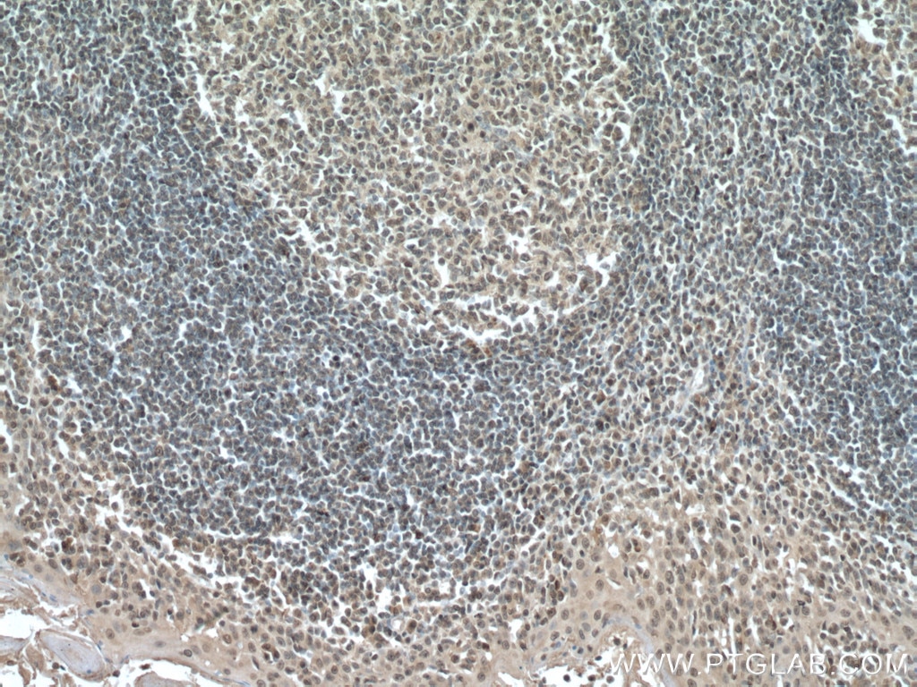 Immunohistochemistry (IHC) staining of human tonsillitis tissue using IRF3 Monoclonal antibody (66670-1-Ig)