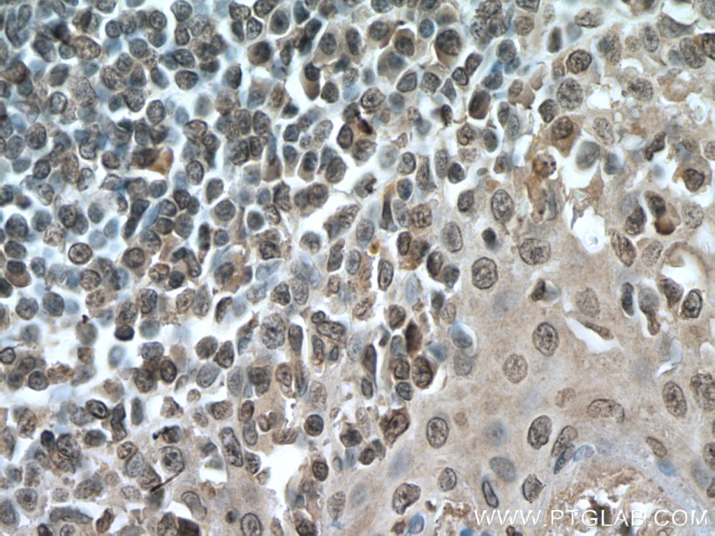 Immunohistochemistry (IHC) staining of human tonsillitis tissue using IRF3 Monoclonal antibody (66670-1-Ig)