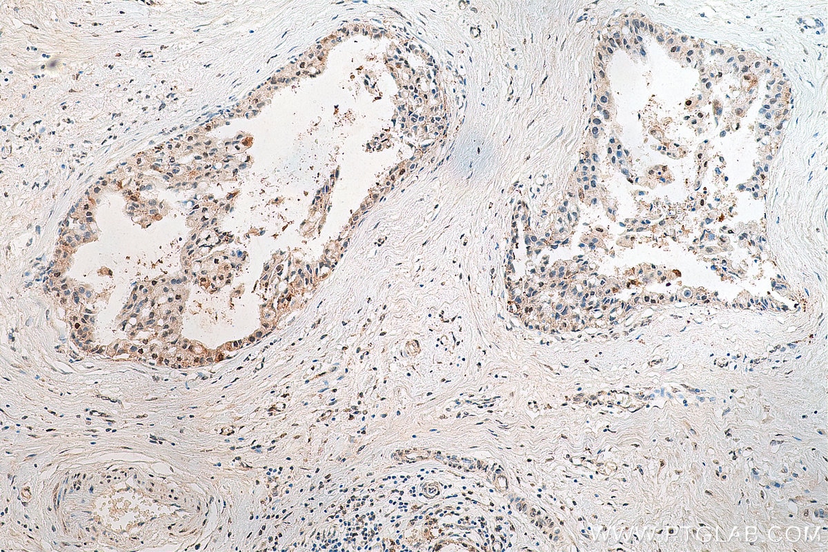 IHC staining of human breast cancer using 80519-1-RR