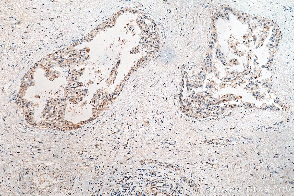 Immunohistochemistry (IHC) staining of human breast cancer tissue using IRF3 Recombinant antibody (80519-1-RR)