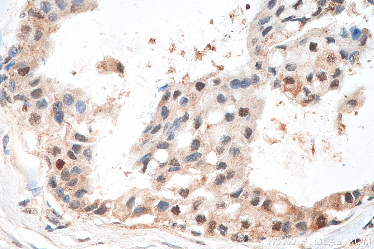 Immunohistochemistry (IHC) staining of human breast cancer tissue using IRF3 Recombinant antibody (80519-1-RR)