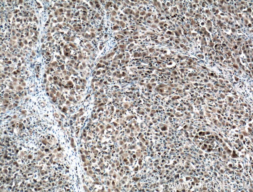 Immunohistochemistry (IHC) staining of human lymphoma tissue using MUM1/IRF4 Polyclonal antibody (11247-2-AP)