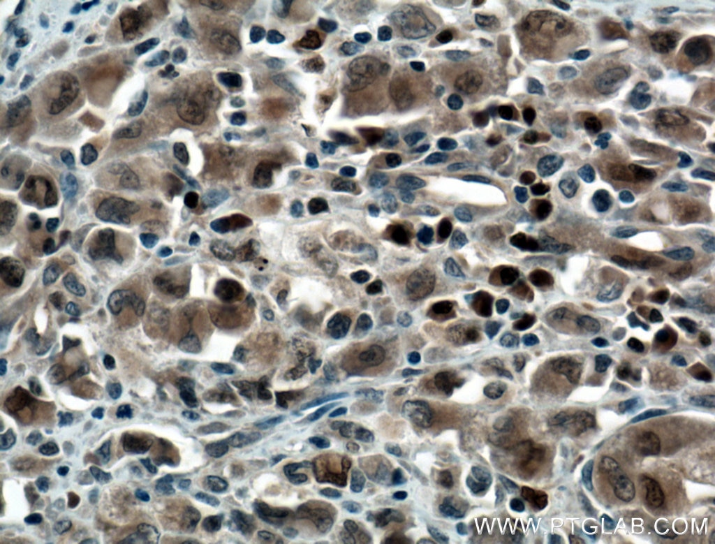 Immunohistochemistry (IHC) staining of human lymphoma tissue using MUM1/IRF4 Polyclonal antibody (11247-2-AP)