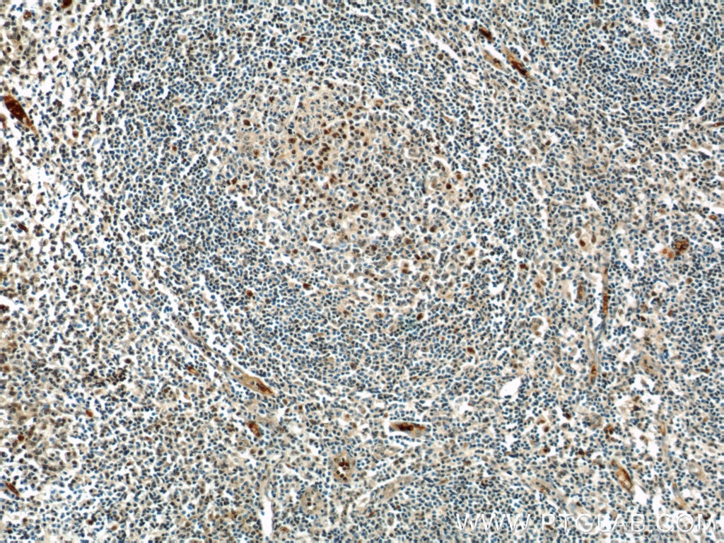 Immunohistochemistry (IHC) staining of human tonsillitis tissue using MUM1/IRF4 Polyclonal antibody (11247-2-AP)