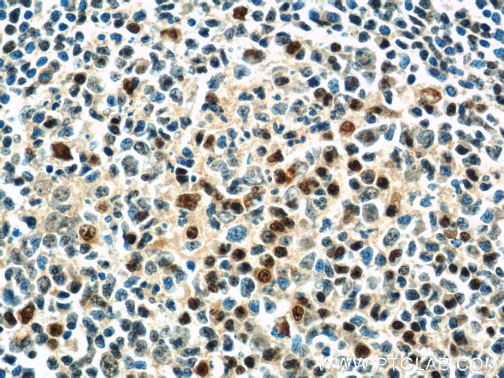 Immunohistochemistry (IHC) staining of human tonsillitis tissue using MUM1/IRF4 Polyclonal antibody (11247-2-AP)