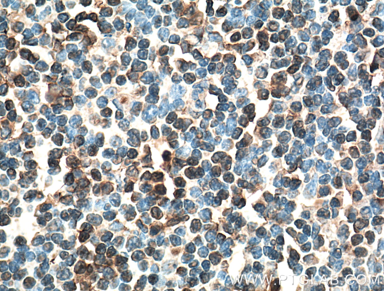 Immunohistochemistry (IHC) staining of human tonsillitis tissue using IRF4 Monoclonal antibody (66451-1-Ig)