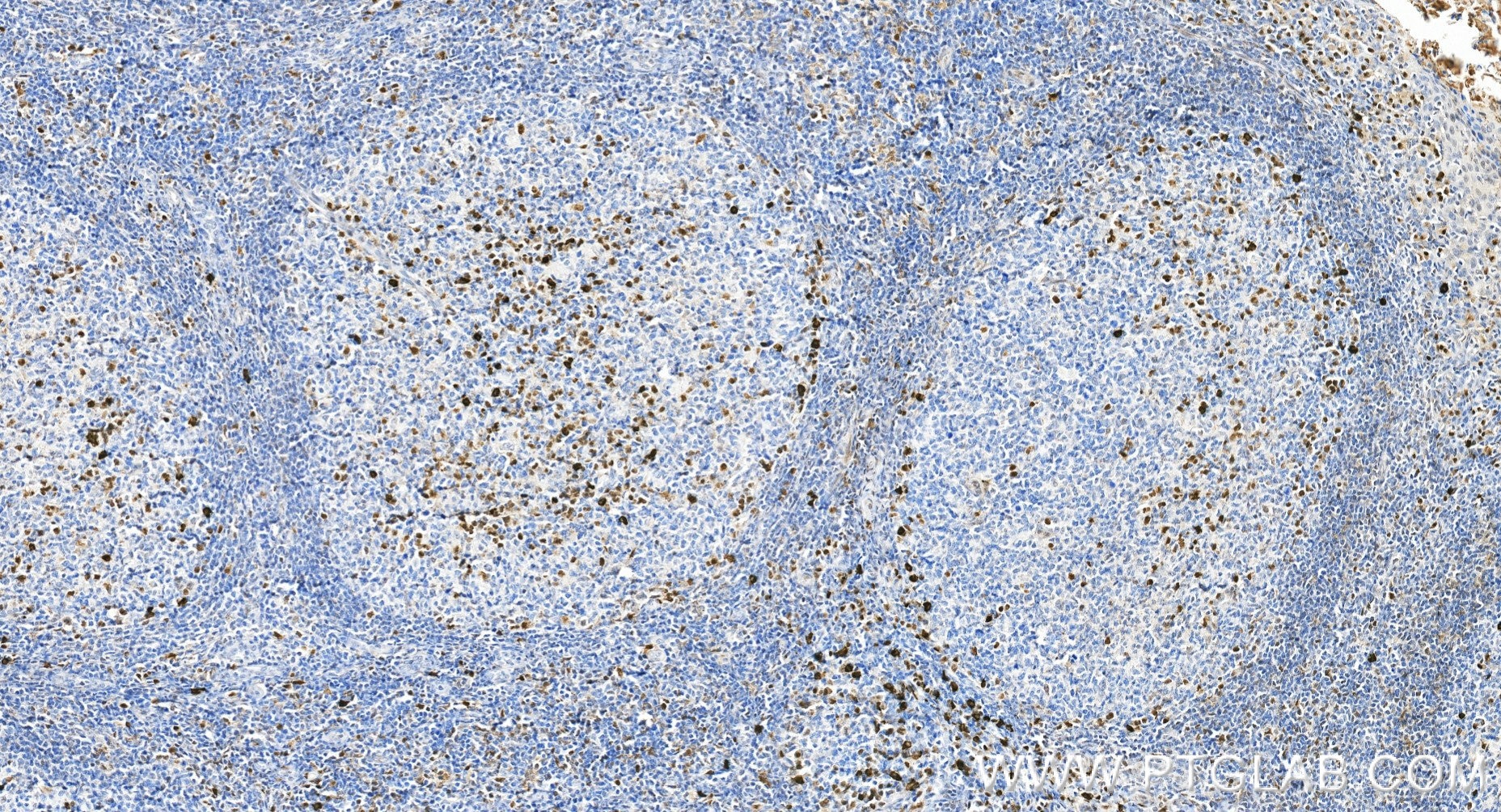 Immunohistochemistry (IHC) staining of human tonsillitis tissue using IRF4 Recombinant monoclonal antibody (87342-1-RR)